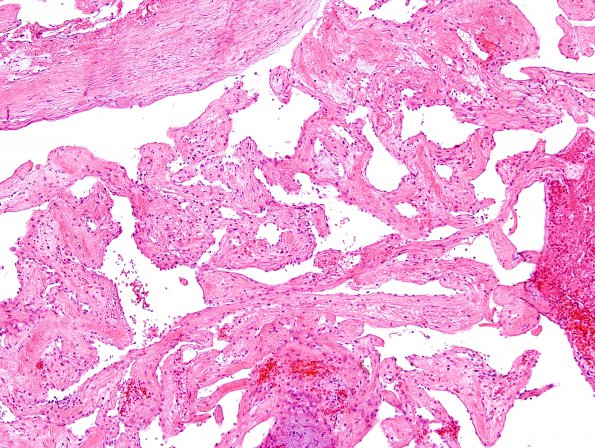 3A3 Intravascular papillary endothelial hyperplasia (Case 3) H&E 9