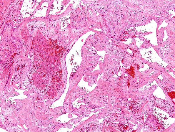 3A4 Intravascular papillary endothelial hyperplasia (Case 3) H&E 10