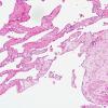 3A5 Intravascular papillary endothelial hyperplasia (Case 3) H&E 8