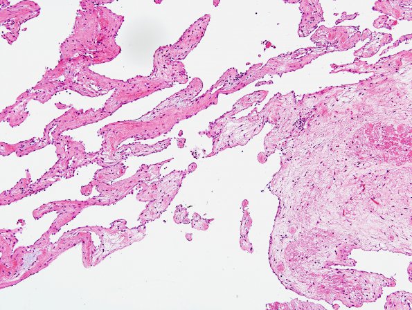 3A5 Intravascular papillary endothelial hyperplasia (Case 3) H&E 8