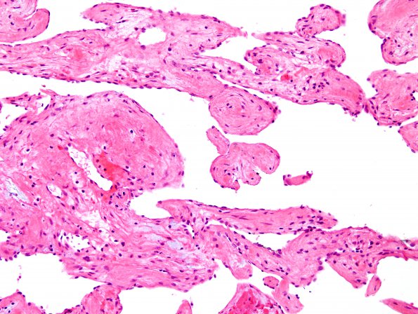 3A6 Intravascular papillary endothelial hyperplasia (Case 3) H&E 13