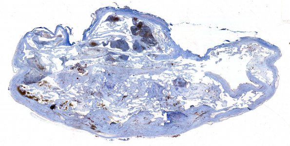 3B1 Intravascular Papillary Endothelial Hyperplasia (Case 3) 1 CD34 WM