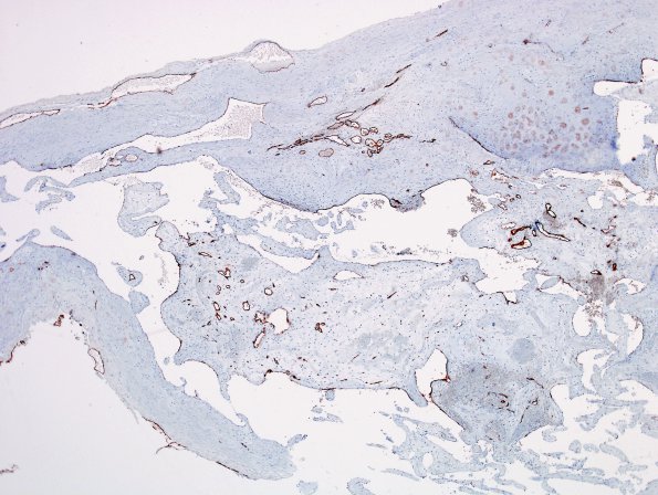 3B2 Intravascular papillary endothelial hyperplasia (Case 3) CD34 7