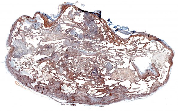 3C1 Intravascular papillary endothelial hyperplasia (Case 3) 1 SMA WM