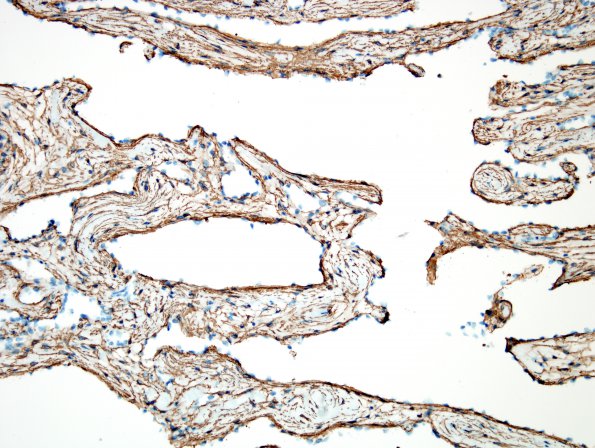 3D3 Intravascular papillary endothelial hyperplasia (Case 3) SMA 1