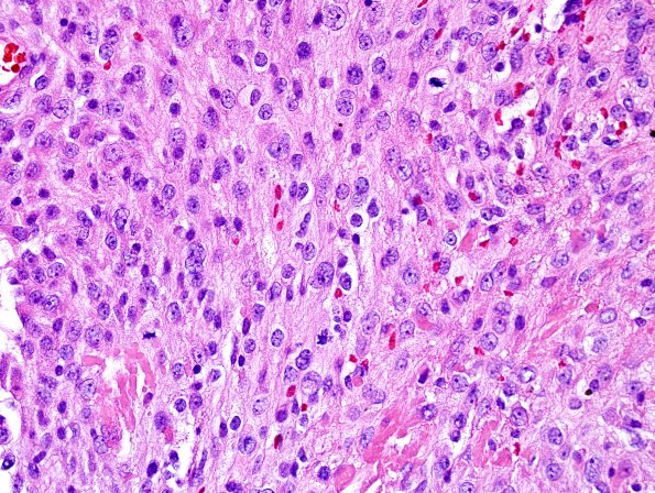 4A1 Meningioma, Radio Rx & Intravascular PEH (Case 4) H&E 33