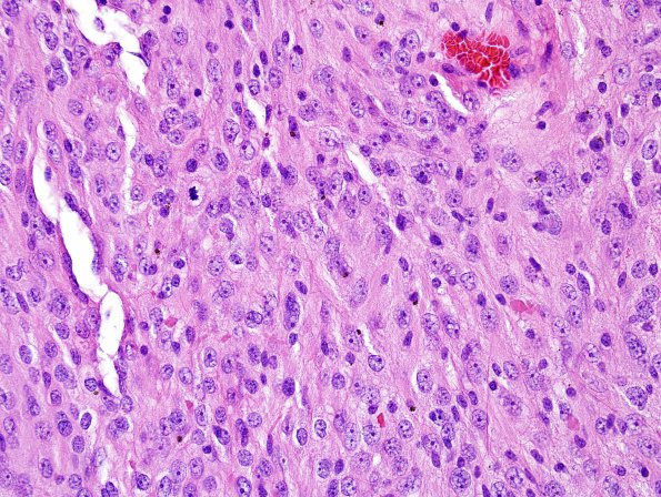 4A2 Meningioma, RadioRx , Intravascular PEH (Case 4) H&E 5