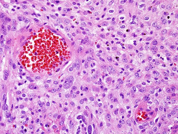 4A3 Meningioma, RadioRx , Intravascular PEH (Case 4) H&E 34