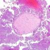 4B1 Meningioma, RadioRx , Intravascular PEH (Case 4) H&E 1