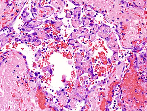 4B10 Meningioma, RadioRx , Intravascular PEH (Case 4) H&E 11