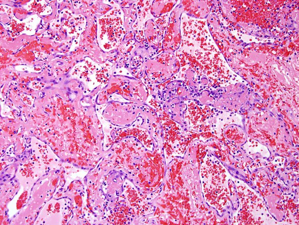 4B11 Meningioma, RadioRx , Intravascular PEH (Case 4) H&E 28