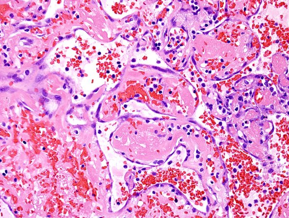 4B12 Meningioma, RadioRx , Intravascular PEH (Case 4) H&E 30