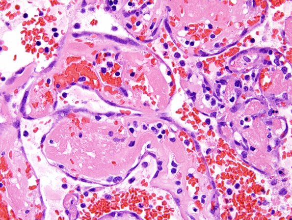 4B13 Meningioma, RadioRx , Intravascular PEH (Case 4) H&E 29