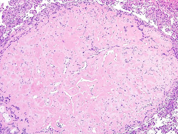 4B2 Meningioma, RadioRx , Intravascular PEH (Case 4) H&E 2