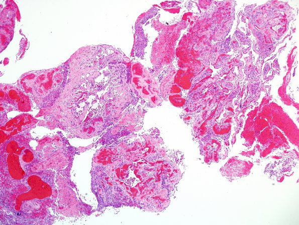 4B3A Meningioma, RadioRx , Intravascular PEH (Case 4) H&E 7