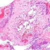 4B3B Meningioma, RadioRx , Intravascular PEH (Case 4) H&E 8