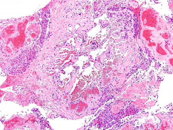 4B3B Meningioma, RadioRx , Intravascular PEH (Case 4) H&E 8