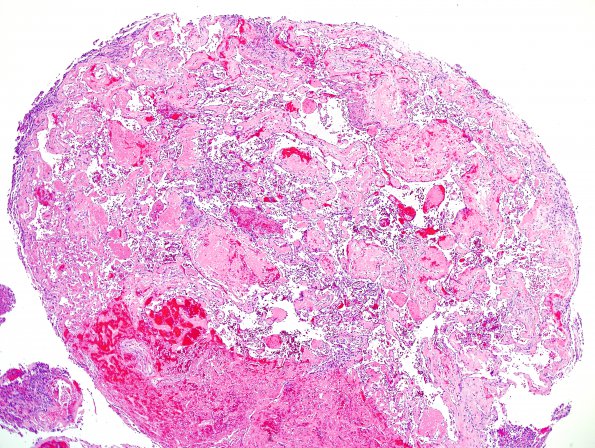 4B4 Meningioma, RadioRx , Intravascular PEH (Case 4) H&E 24