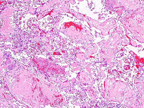 4B5 Meningioma, RadioRx , Intravascular PEH (Case 4) H&E 26