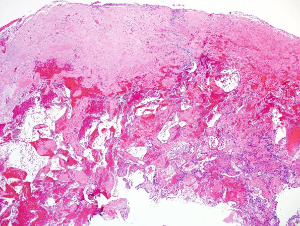 4B6 Meningioma, RadioRx , Intravascular PEH (Case 4) H&E 21