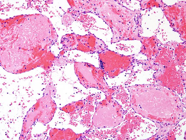 4B7 Meningioma, RadioRx , Intravascular PEH (Case 4) H&E 18