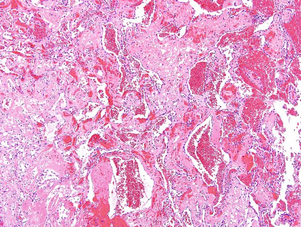 4B8 Meningioma, RadioRx , Intravascular PEH (Case 4) H&E 20