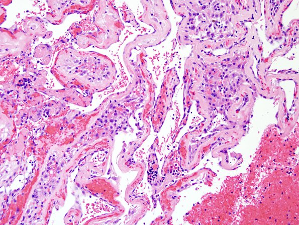 4B9 Meningioma, RadioRx , Intravascular PEH (Case 4) H&E 9