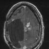 5A2 PEH (Masson Tumor, Case 5) T1 with contrast 1 - Copy