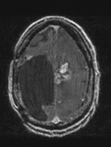 5A2 PEH (Masson Tumor, Case 5) T1 with contrast 1 - Copy