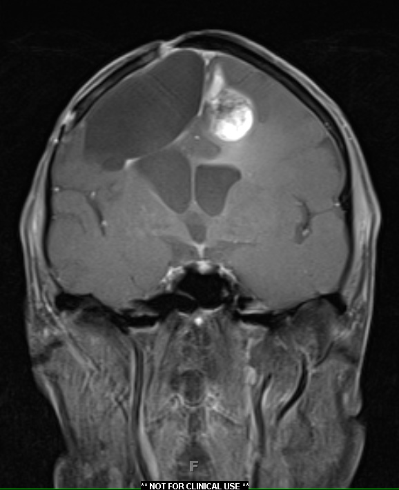 5A3 PEH 13 yr GBM Rx (Masson Tumor, Case 5) T1 with contrast - Copy