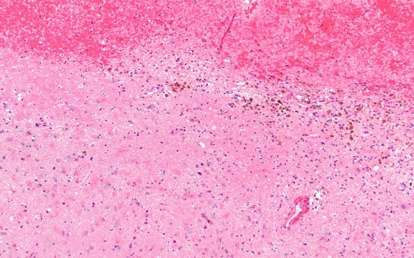 5B2 Masson Tumor (Case 5) B2 H&E 10X