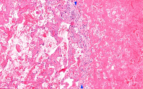 5B3 Masson Tumor (Case 5) B1 H&E 10X 1 copy