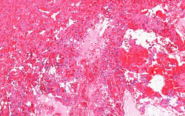 5B4 Masson Tumor (Case 5) H&E 10X