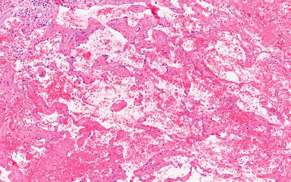 5B5 Masson Tumor (Case 5) B2 H&E 10X 2