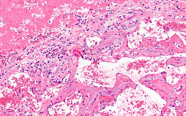 5B6 Masson Tumor (Case 5) B1 H&E 20X 2