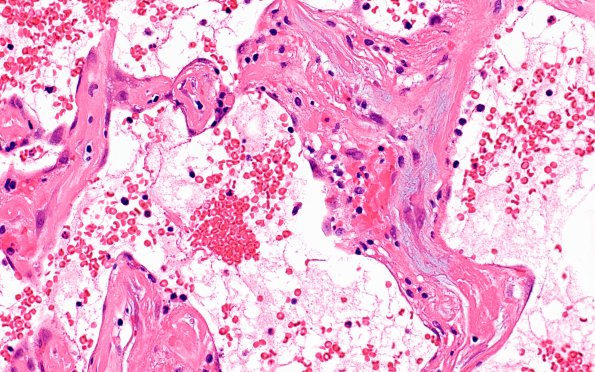 5B8 Masson Tumor (Case 5) B1 H&E 40X 2