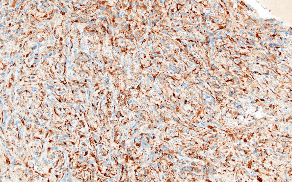 5E3 Masson Tumor (Case 5) FXIIIA 20X