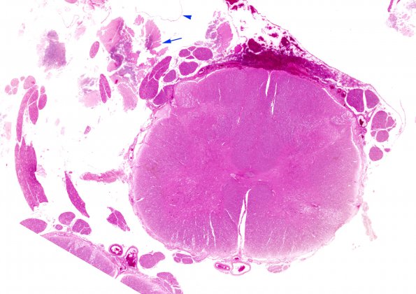 1B1 Autolysis, Cerebellum, necrotic in lumbosacral SAS (Case 1) H&E 2 copy