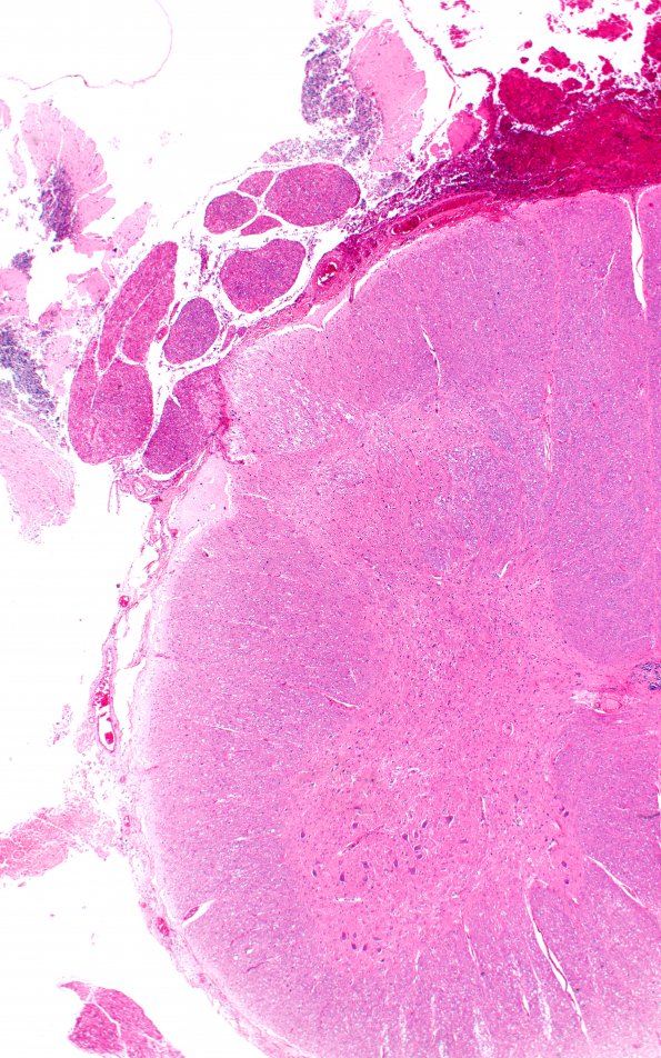 1B2 Autolysis, Cerebellum, necrotic in lumbosacral SAS (Case 1) H&E 2