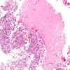 1B3 Autolysis, Cerebellum, necrotic in lumbosacral SAS (Case 1) H&E 2