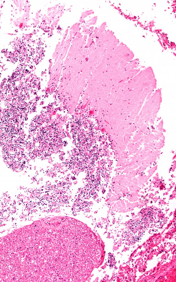 1B3 Autolysis, Cerebellum, necrotic in lumbosacral SAS (Case 1) H&E 2