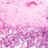 1B4 Autolysis, Cerebellum, necrotic in lumbosacral SAS (Case 1) H&E 2 copy