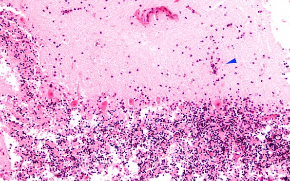 1B4 Autolysis, Cerebellum, necrotic in lumbosacral SAS (Case 1) H&E 2 copy