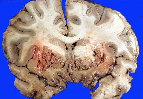 2A4 Autolysis (Case 2) gross 1