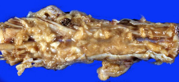 2A5 Autolysis subarachnoid spread (Case 2) gross 1