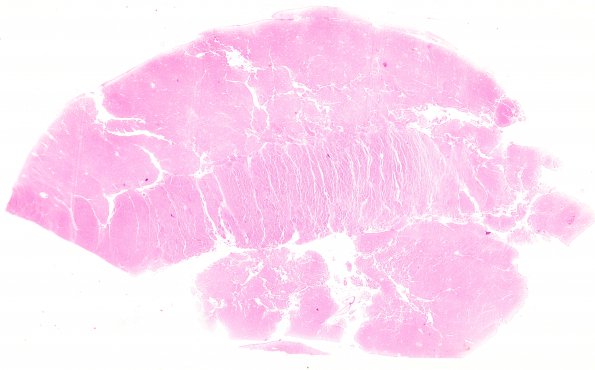 2B1 Autolysis (Case 2) H&E WM BG