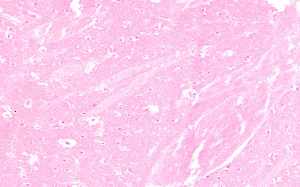 2B2 Autolysis (Case 2) H&E 20X