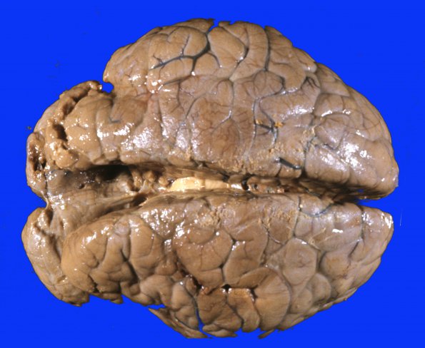 3A1 Autolysis (Case 3) respirator brain gross 1