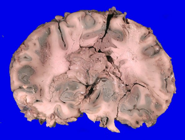 4A2 Autolysis (Respirator Brain) (Case 4)