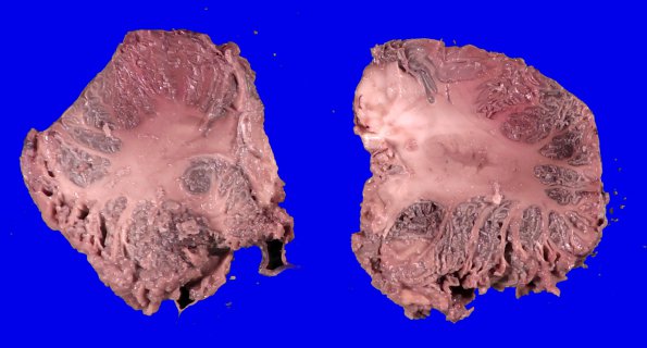 4A3 Autolysis (Respirator Brain) (Case 4))